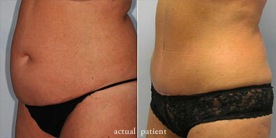 5 Signs You Might Need a Tummy Tuck