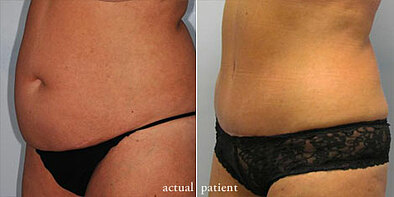 Abdominoplasty will Make You Perfect