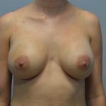 Breast Augmentation Before & After Patient #691