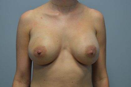 Breast Augmentation Before & After Patient #691