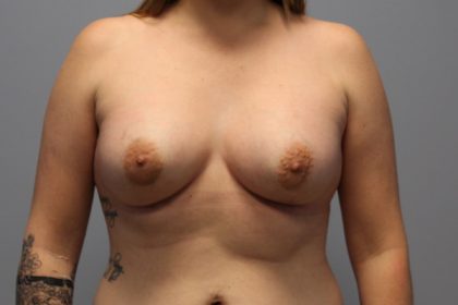Corrective Breast Procedures Before & After Patient #696