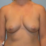 Breast Augmentation Before & After Patient #714