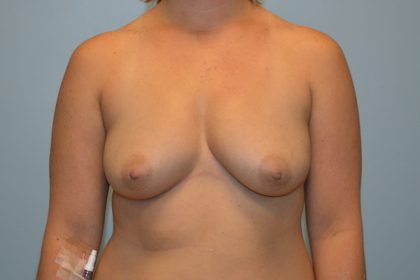 Breast Augmentation Before & After Patient #714