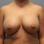 Breast Augmentation Before & After Patient #714