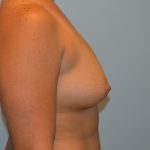 Breast Augmentation Before & After Patient #714