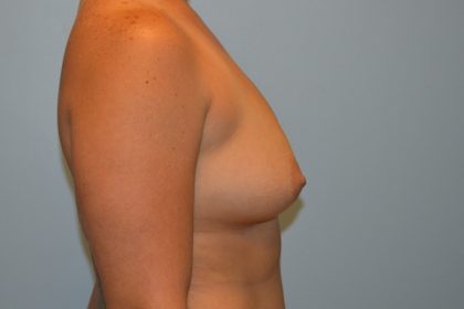 Breast Augmentation Before & After Patient #714