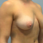 Breast Augmentation Before & After Patient #721