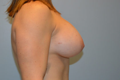 Breast Augmentation Before & After Patient #721