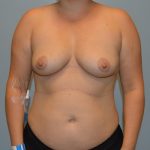 Breast Augmentation Before & After Patient #767