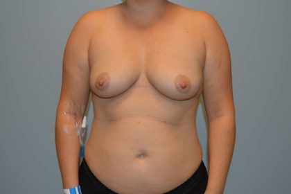 Breast Augmentation Before & After Patient #767