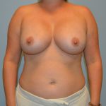 Breast Augmentation Before & After Patient #767