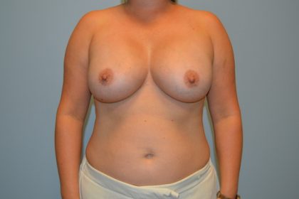 Breast Augmentation Before & After Patient #767