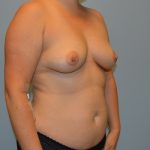 Breast Augmentation Before & After Patient #767
