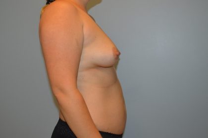 Breast Augmentation Before & After Patient #767