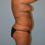 Liposuction Before & After Patient #675