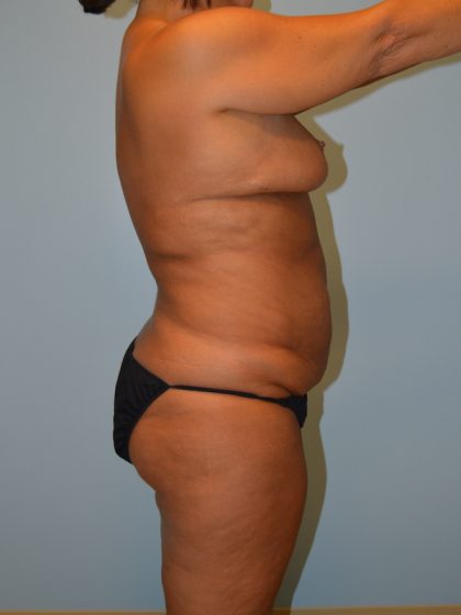 Liposuction Before & After Patient #675