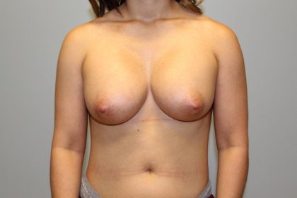 Breast Augmentation Before & After Patient #774