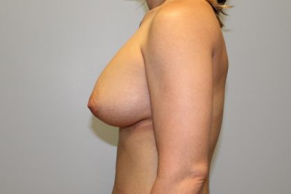 Breast Augmentation Before & After Patient #774