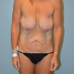 Liposuction Before & After Patient #681