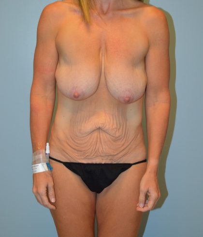 Liposuction Before & After Patient #681