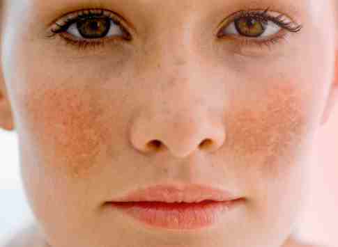 Melasma