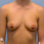 Breast Augmentation Before & After Patient #733