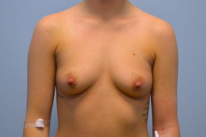 Breast Augmentation Before & After Patient #733