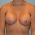 Breast Augmentation Before & After Patient #733