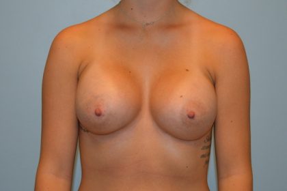 Breast Augmentation Before & After Patient #733