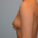 Breast Augmentation Before & After Patient #733