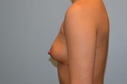 Breast Augmentation Before & After Patient #733