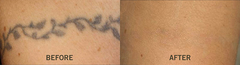 Tattoo Removal Ooltewah