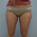 Fat Reduction (Non-Invasive) Before & After Patient #653