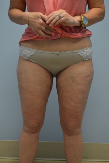 Fat Reduction (Non-Invasive) Before & After Patient #653