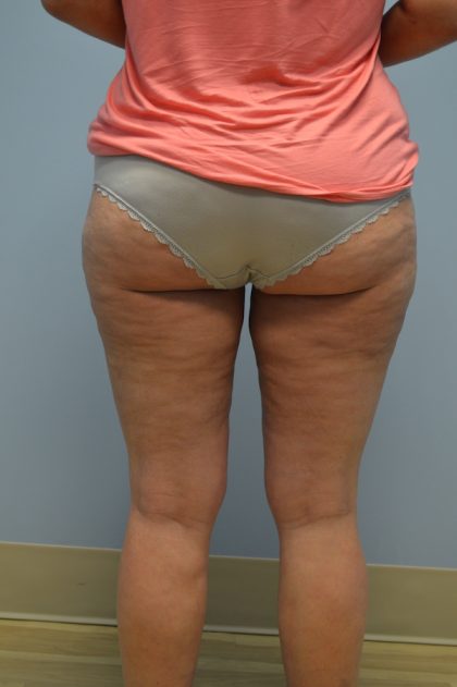 Fat Reduction (Non-Invasive) Before & After Patient #653