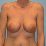 Corrective Breast Procedures Before & After Patient #741