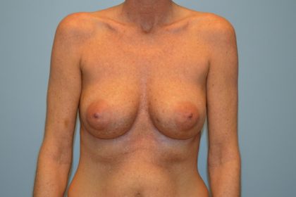 Corrective Breast Procedures Before & After Patient #741
