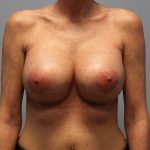 Corrective Breast Procedures Before & After Patient #741