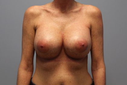 Corrective Breast Procedures Before & After Patient #741