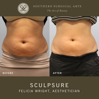Q & A: Beat Belly Fat (and More) with SculpSure
