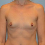 Breast Augmentation Before & After Patient #746