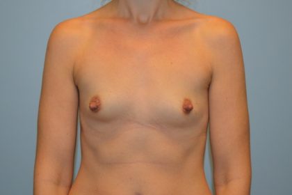 Breast Augmentation Before & After Patient #746
