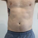 Fat Reduction (Non-Invasive) Before & After Patient #2998