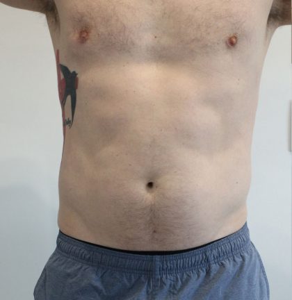 Fat Reduction (Non-Invasive) Before & After Patient #2998