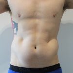 Fat Reduction (Non-Invasive) Before & After Patient #2998