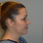 FaceTite (Non-Invasive Skin Tightening) Before & After Patient #2788