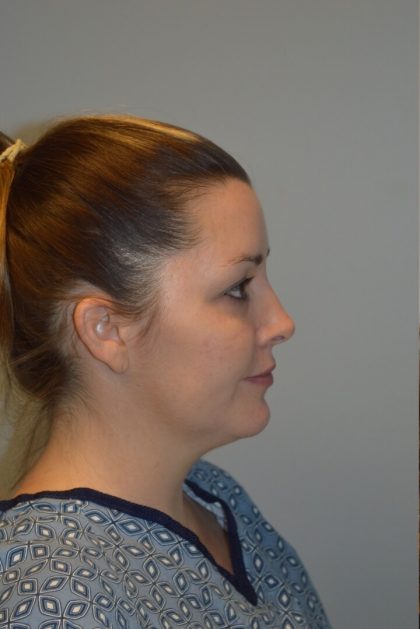 FaceTite (Non-Invasive Skin Tightening) Before & After Patient #2788