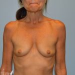 Breast Augmentation Before & After Patient #2819