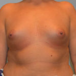 Breast Augmentation Before & After Patient #2912