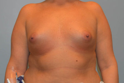 Breast Augmentation Before & After Patient #2912